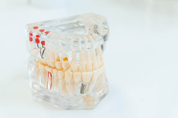 Placing Crowns On Dental Implants