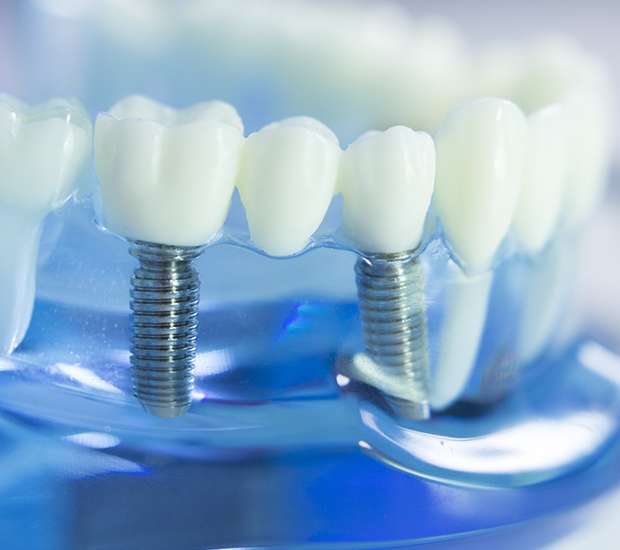 Milwaukie Dental Implants