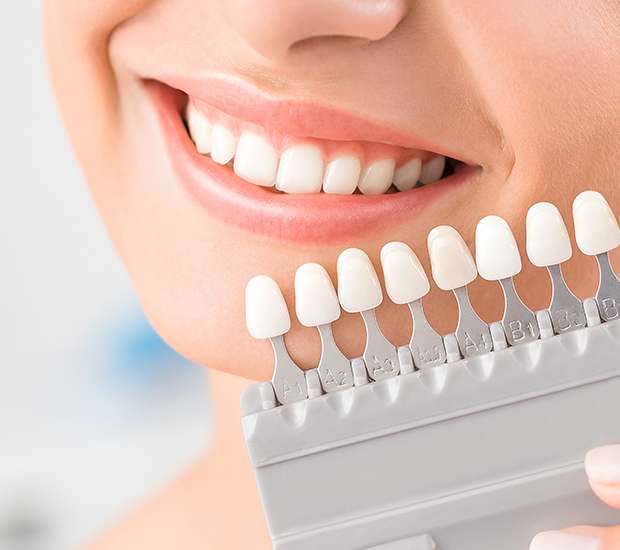Milwaukie Dental Veneers and Dental Laminates