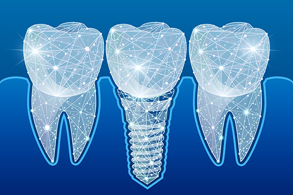 Preventing Complications After Getting Dental Implants from Compassion Family Dentistry in Milwaukie, OR